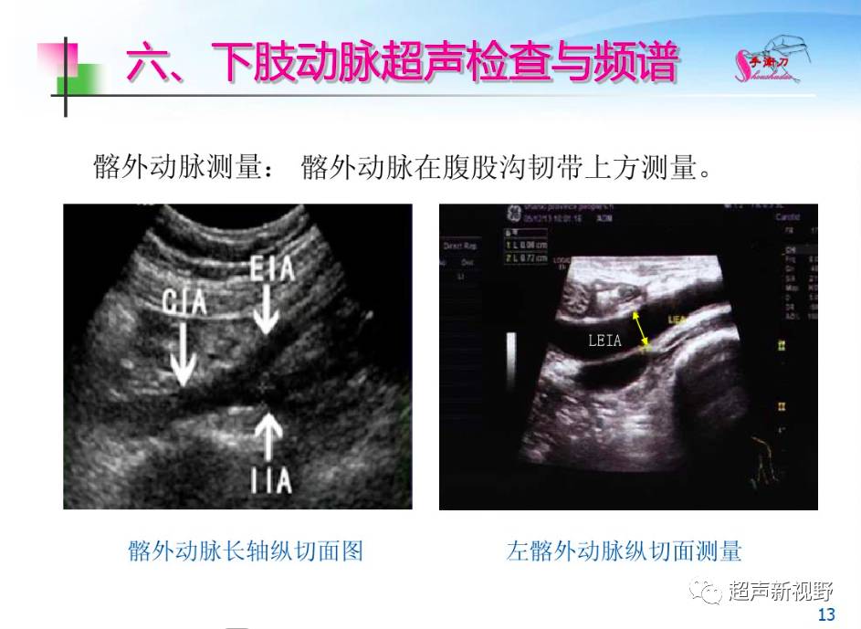 科普| 下肢血管的超声检查与正常声像图