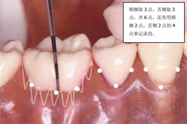 【牙周治疗笔记】学习牙周基础治疗之探针