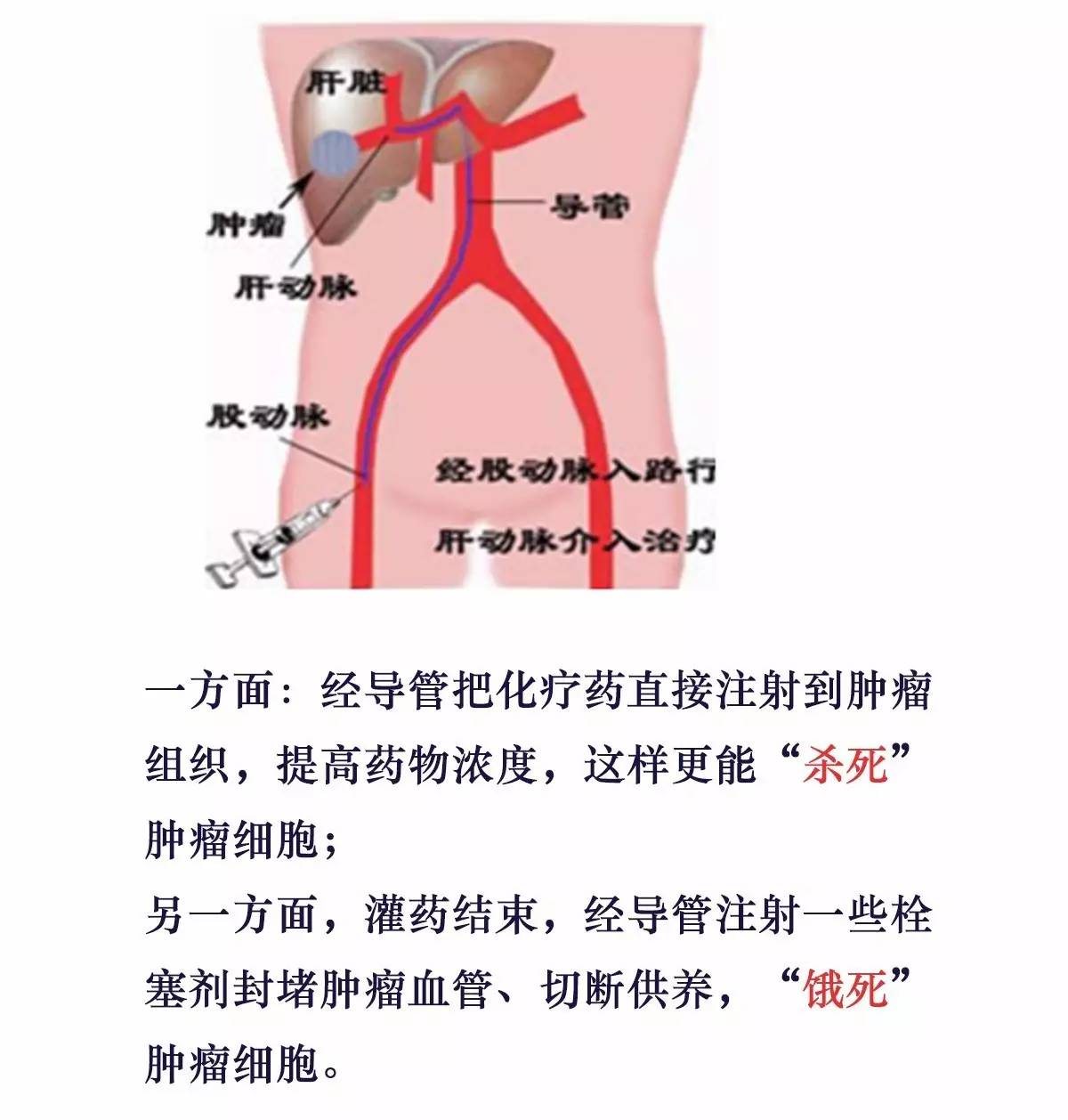 化疗原理是什么_化疗是什么过程图解(3)