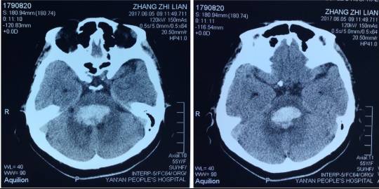 脑干出血9ml深度昏迷 延安市人民医院神经外科行显微