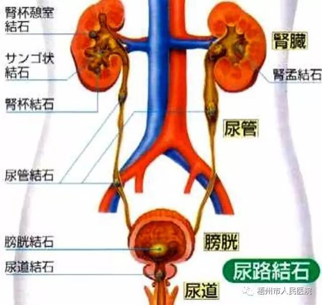 【健康资讯】梧州市人民医院开展经尿道输尿管镜钬激光碎石,轻松清除