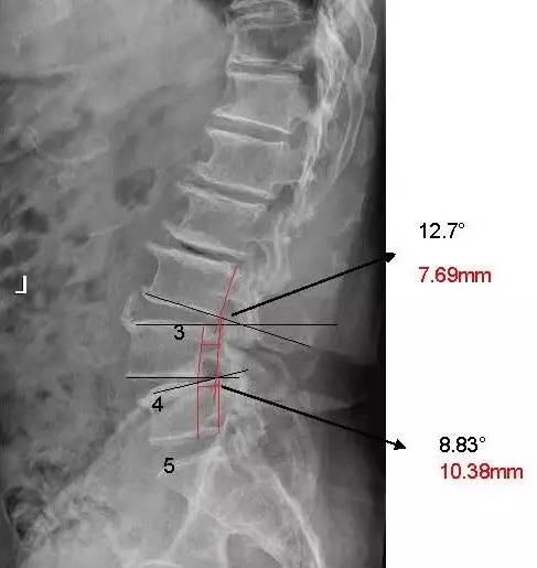 5mm角度 变化2.62°;l4/5位移2.71mm角度变化5.