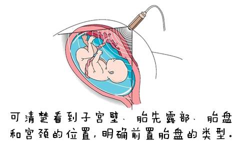 以产妇安全为主,在母体安全的前提下,尽量避免胎儿早产,以减少新生儿