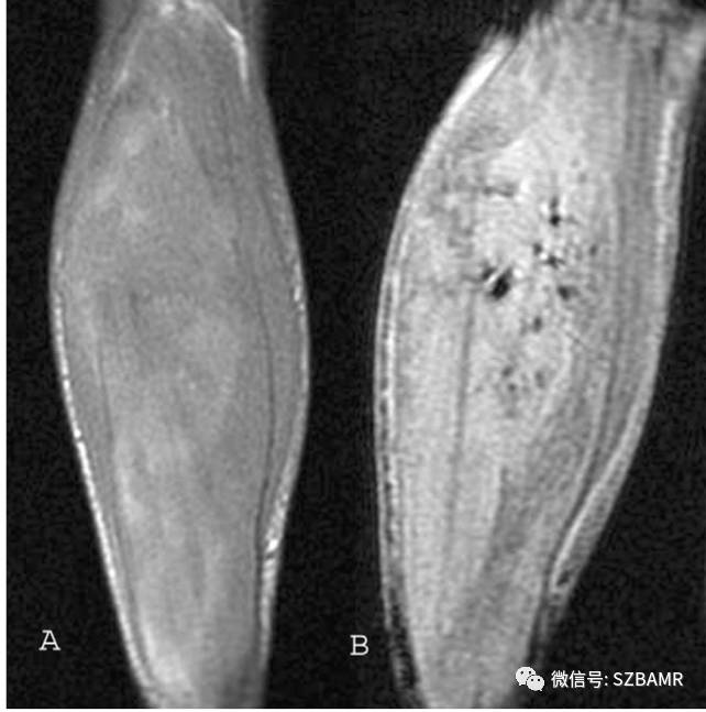 轴位t2压脂显示大腿外展肌(a)和小腿胫骨后肌,比目鱼肌,腓肠肌高信号
