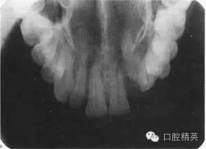 上颌切牙和尖牙的根尖x线片图39.2这些x线片显示了什么?