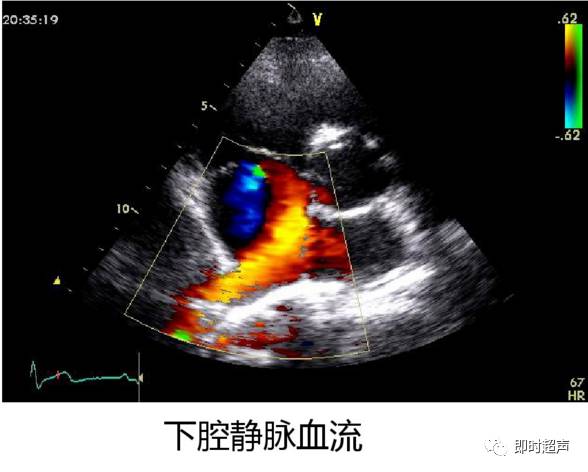 正常心脏超声解剖