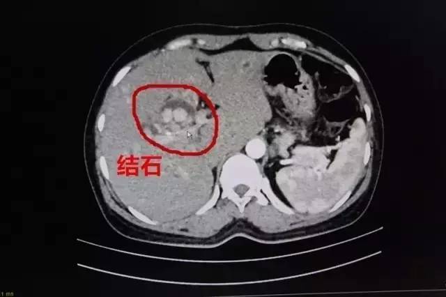 北海震惊一市民三餐这样吃体内取出200多颗结石你还敢吗