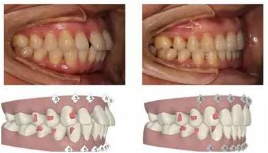 如果牙齿拥挤非常严重,则可以采用拔牙矫正,使前牙明显内收,从而改善
