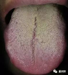 舌苔会把下面的红给盖住,所以有些人舌红,但是苔并不薄,这是阴虚被水