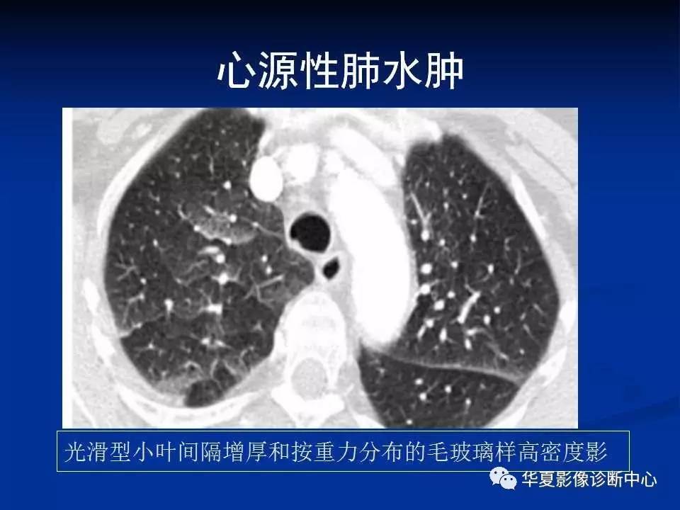 影像基础不同类型肺水肿的ct表现