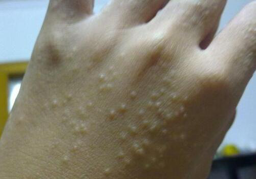 皮肤总爱起疹子,有时手脚患有小疱疹甚至脱皮,脸上,头发总爱出油,黏腻