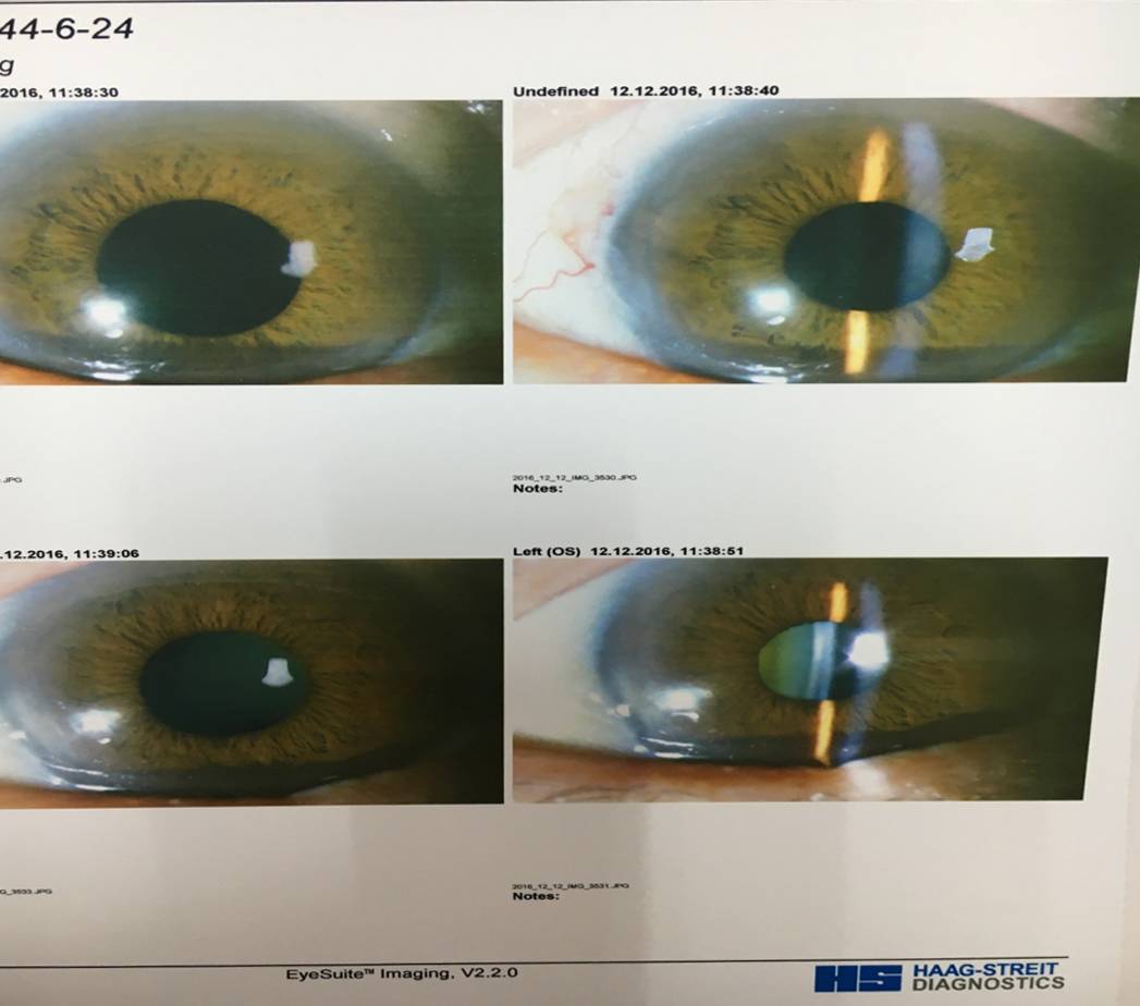 郭海科教授:多焦及老视人工晶体应用进展及规范 保证手术全程精确