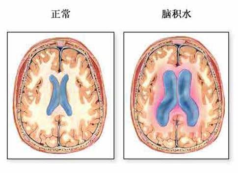 盘点成人两大脑积水常见类型,熟悉相关症状表现