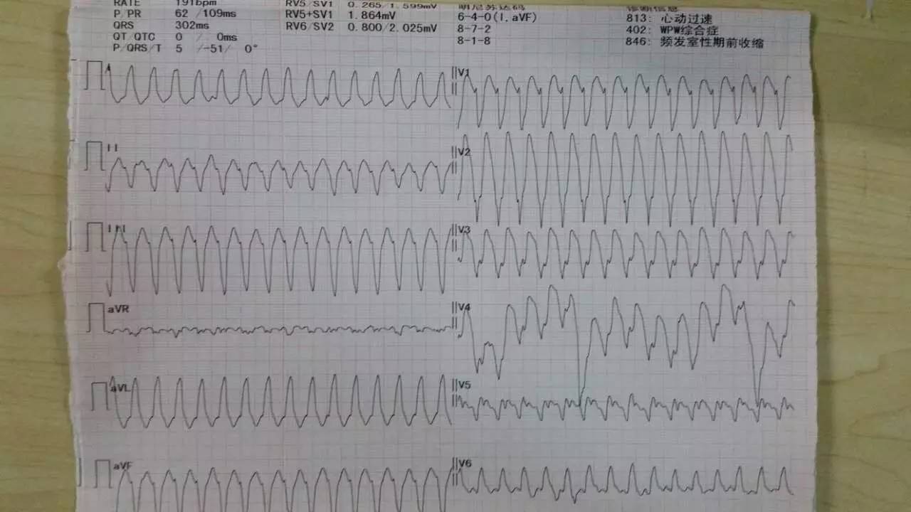 微新闻心脏同步电复律转复顽固性室速患者1例