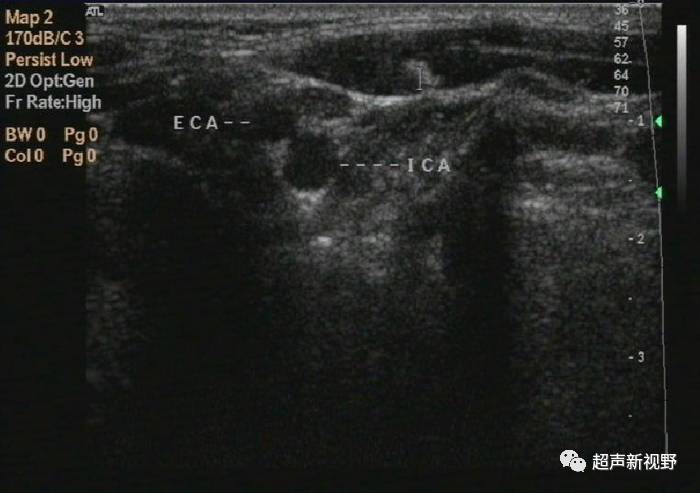 【超声微课堂】颈动脉超声检查及诊断标准