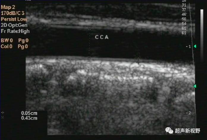 【超声微课堂】颈动脉超声检查及诊断标准