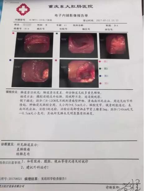 赶走直肠癌病魔!