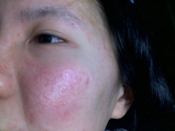 脸部皮肤过敏的症状,秋季三步基础护肤步骤