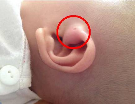你家宝宝耳朵上有这种小孔吗?如果有,就要小心了!