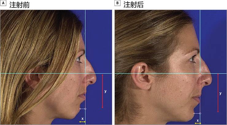 头影测量分析,颏点(x,黄色箭头)的水平位置与穿过鼻根点的垂直线有关