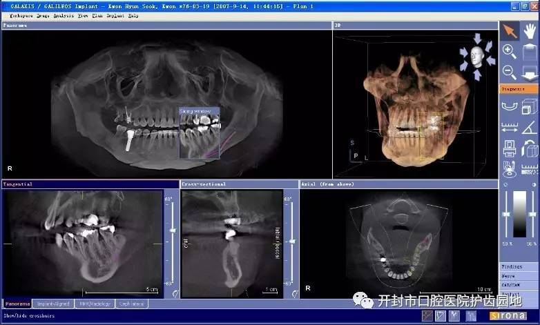 【科普】口腔锥形束ct知多少