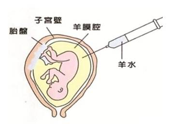 唐筛高危,做羊水穿刺的孕妇要做好哪些准备?