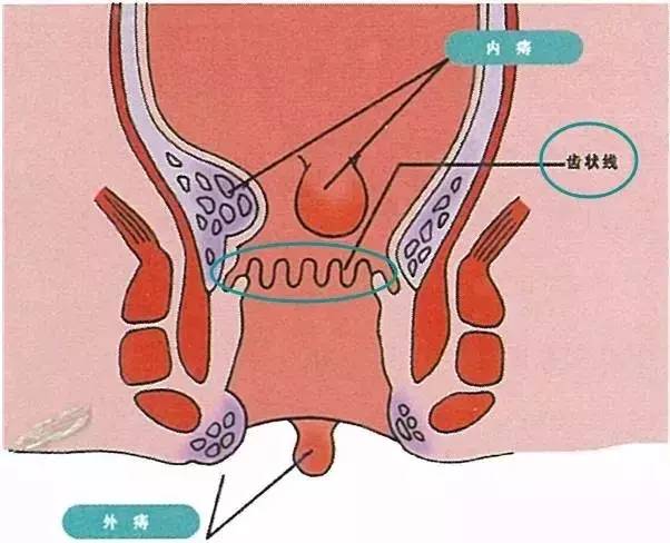 每类痔疮症状各有不同,临床诊断依据也不尽相同. 上面说