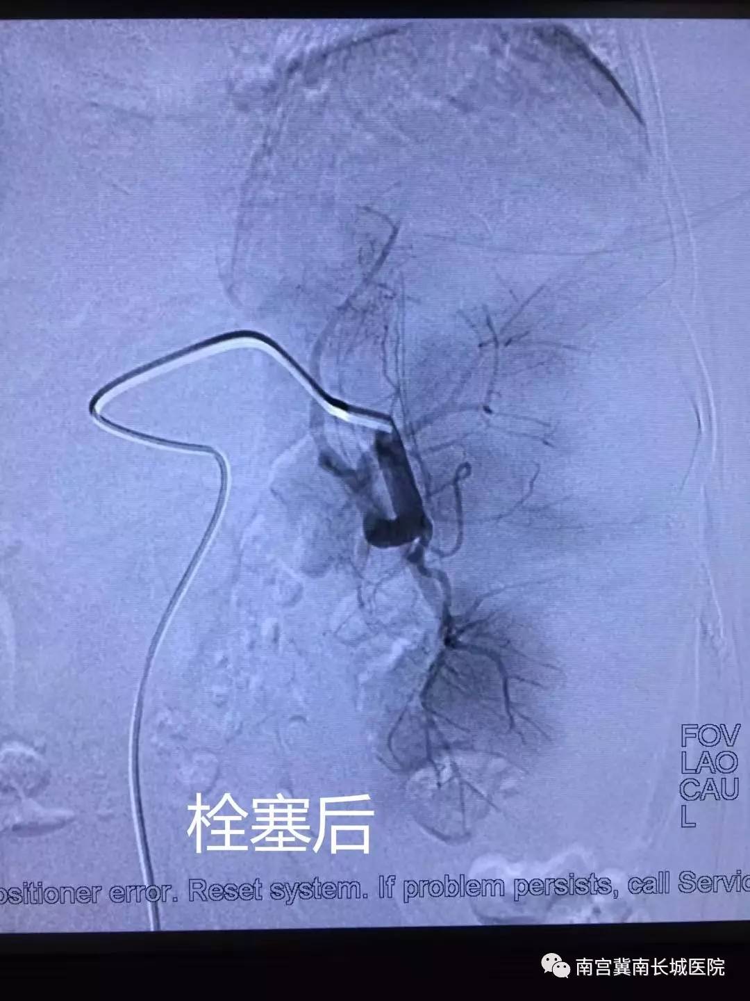 消化内科成功完成第二例脾动脉栓塞介入治疗