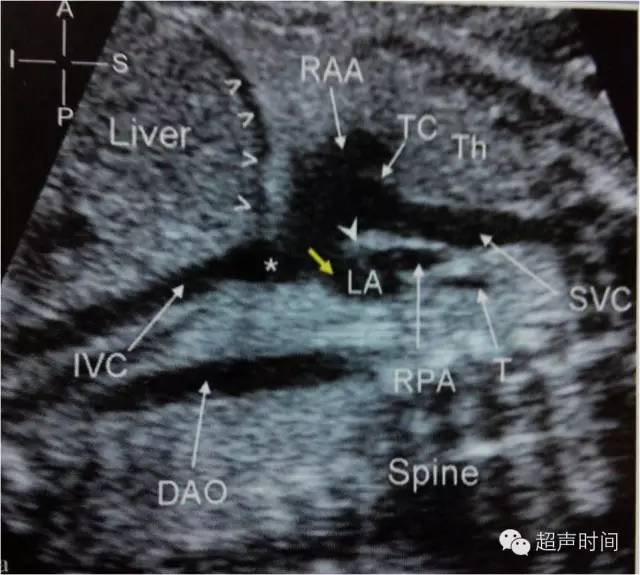 【超声微课堂】胎儿心脏超声常用切面