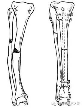 膝关节老年性骨关节炎的"金字塔"治疗模式