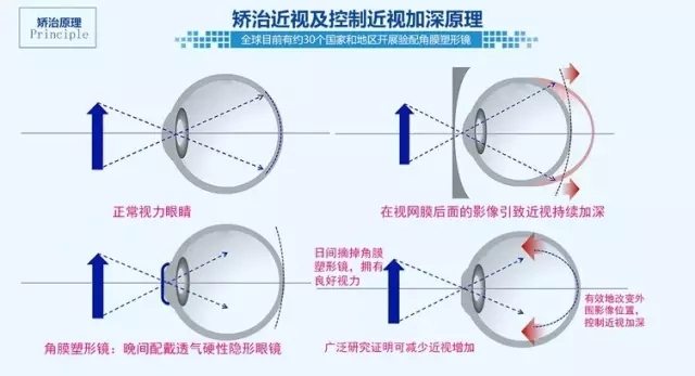 手术治疗近视是什么原理_近视激光手术原理图解