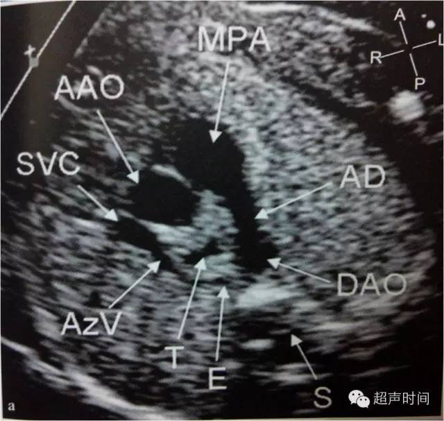 三血管-气管切面可见畸形