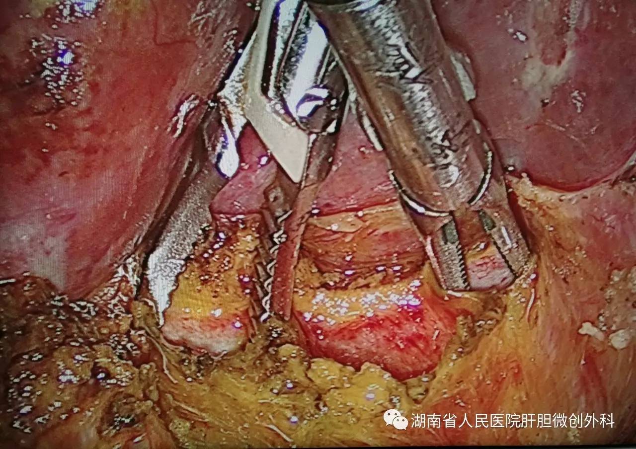 12龄儿童成功行腹腔镜下巨大先天性胆总管囊肿切除术!