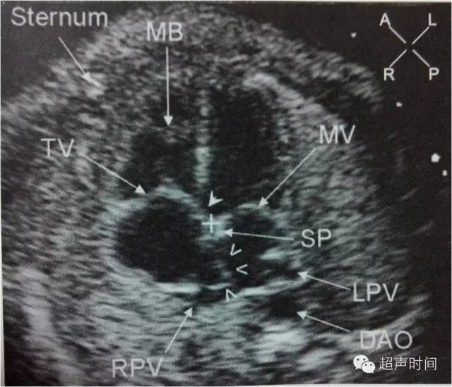 【超声微课堂】胎儿心脏超声常用切面
