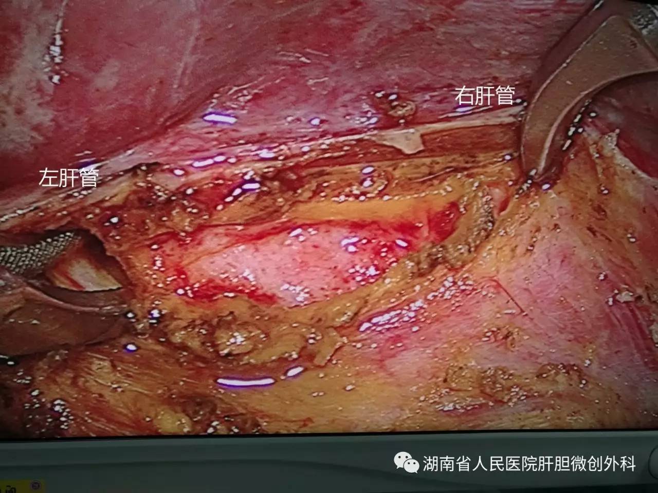 12龄儿童成功行腹腔镜下巨大先天性胆总管囊肿切除术