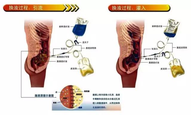 腹透是有残余肾功能的esrd患者之优选治疗