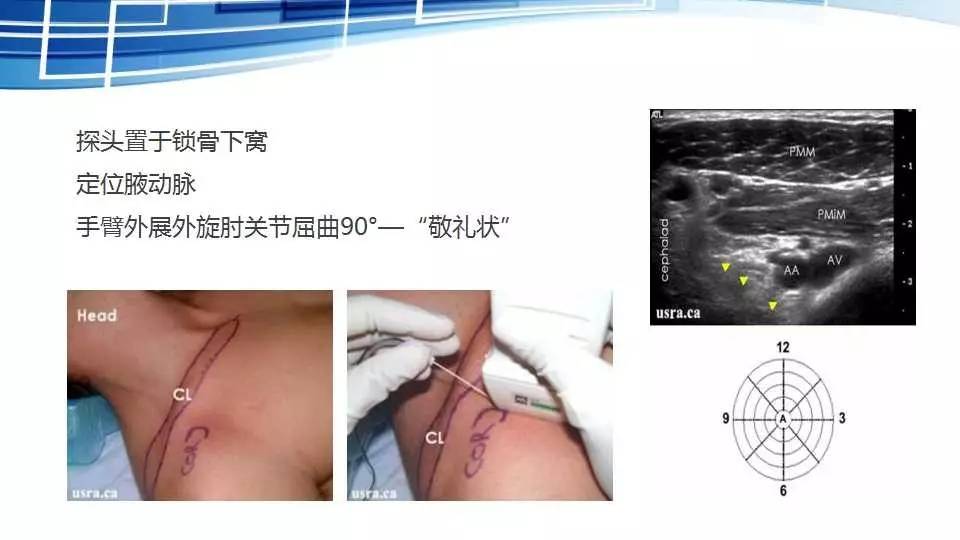 麻醉讲堂臂丛神经阻滞