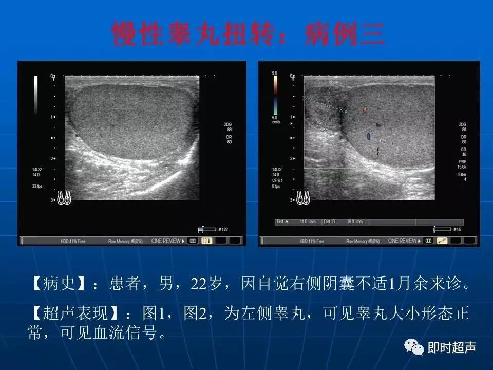 文章内容 急性阴囊疾病的彩色多普勒超声诊断 睾丸异常的疾病类型