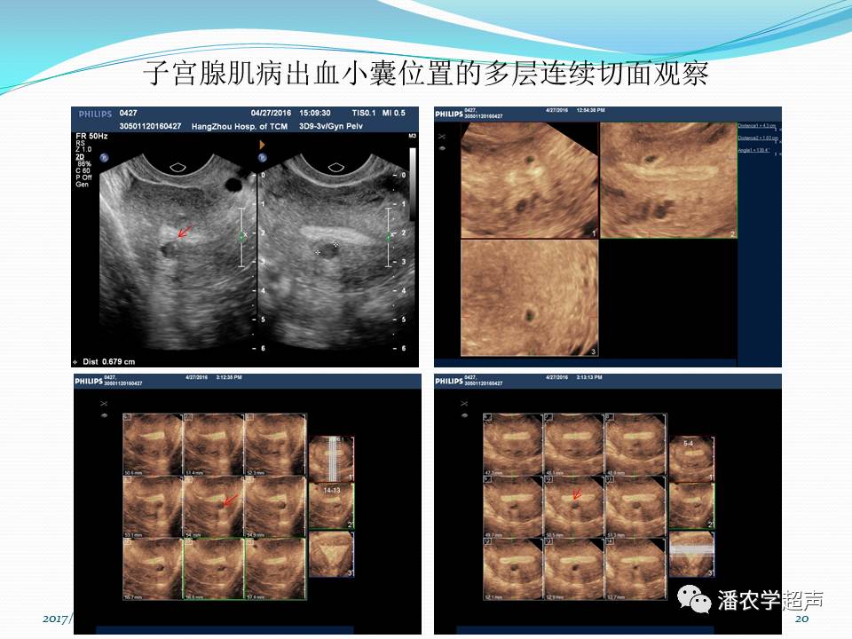 【超声微课堂】子宫内膜异位症:子宫腺肌病