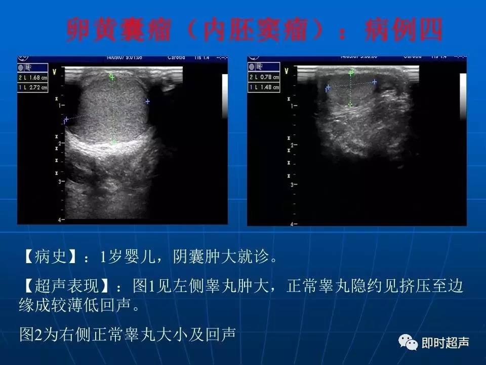 阴囊疾病超声诊断