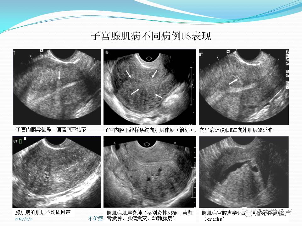 【超声微课堂】子宫内膜异位症:子宫腺肌病