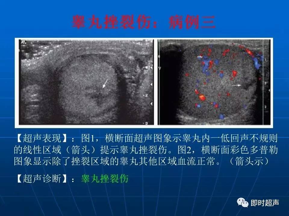 阴囊疾病超声诊断