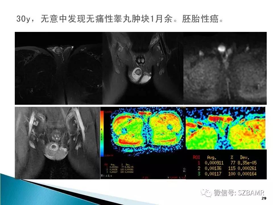 睾丸肿瘤病变mr诊断