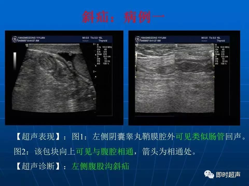 阴囊疾病超声诊断