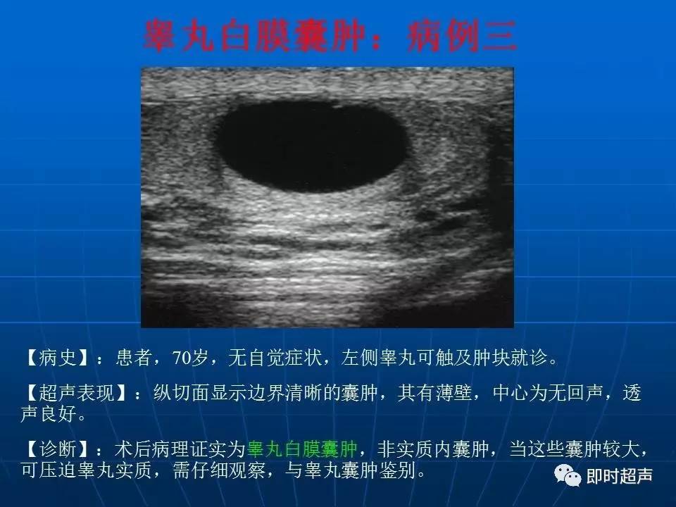 阴囊疾病超声诊断