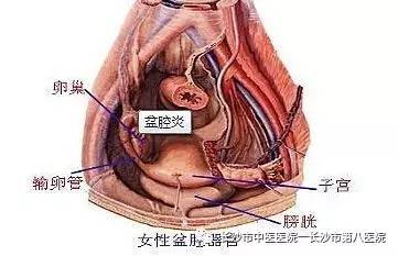 慢性盆腔痛的病因有慢性盆腔炎,子宫内膜异位症,子宫腺肌病,盆腔粘连