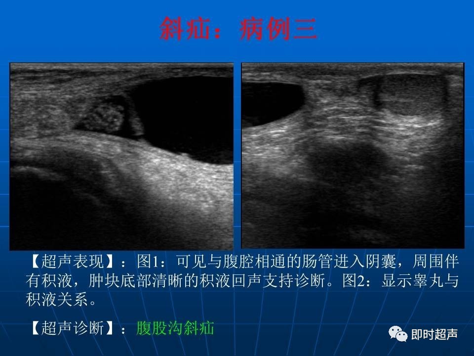 阴囊疾病超声诊断