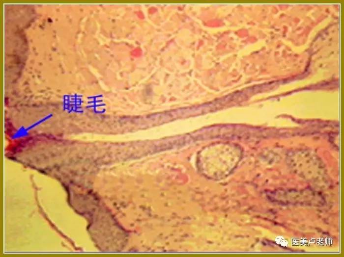 睫毛的皮脂腺称睑缘腺或zeiss腺,感染时形成麦粒肿.