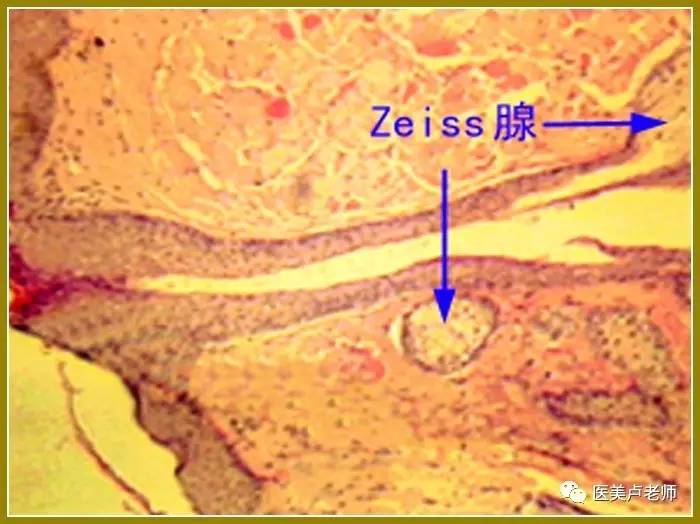 睫毛的皮脂腺称睑缘腺或zeiss腺,感染时形成麦粒肿.