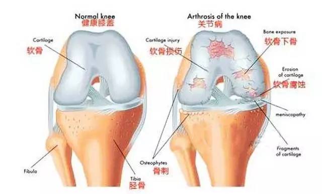 跑步膝盖疼怎么治疗